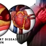 Mechanism Of Action How Fat Causes Heart Disease Unknown​